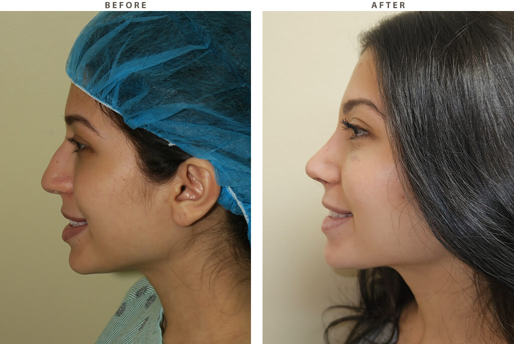 Rhinoplasty - Before and After Pictures