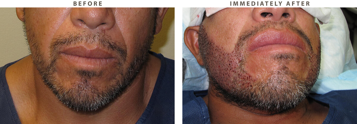 Facial Hair Transplant Chicago - Before and After Pictures