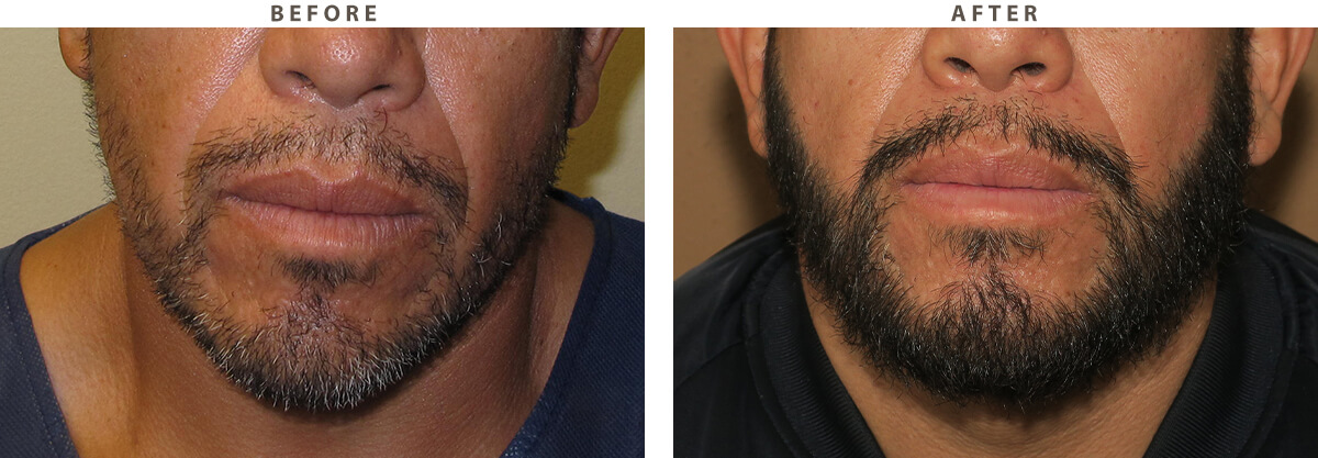 Facial Hair Transplant Chicago - Before and After Pictures