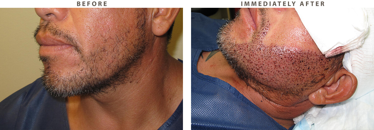 Facial Hair Transplant Chicago - Before and After Pictures