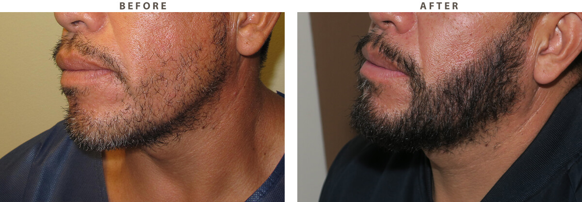 Facial Hair Transplant Chicago - Before and After Pictures