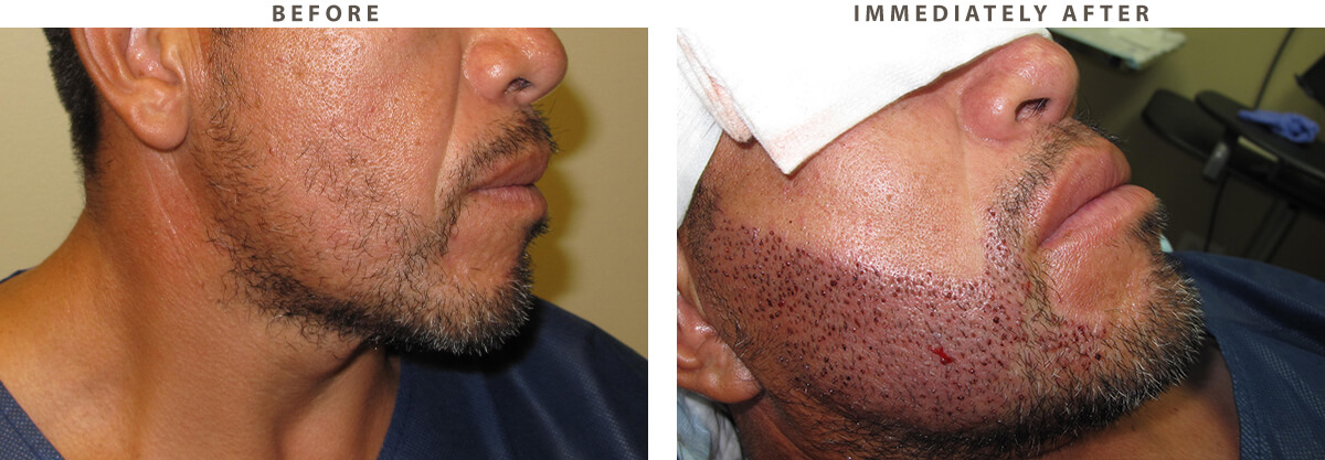 Facial Hair Transplant Chicago - Before and After Pictures