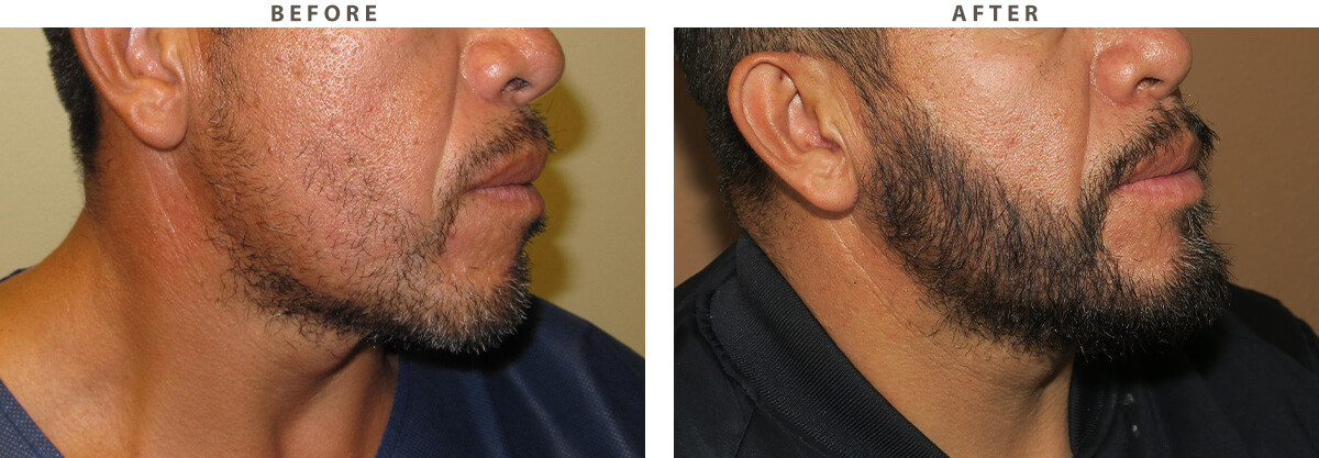 Facial Hair Transplant Chicago - Before and After Pictures