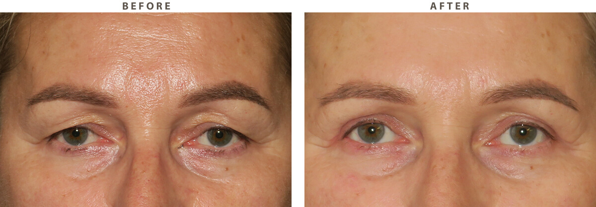 Blepharoplasty Chicago - Before and After Pictures