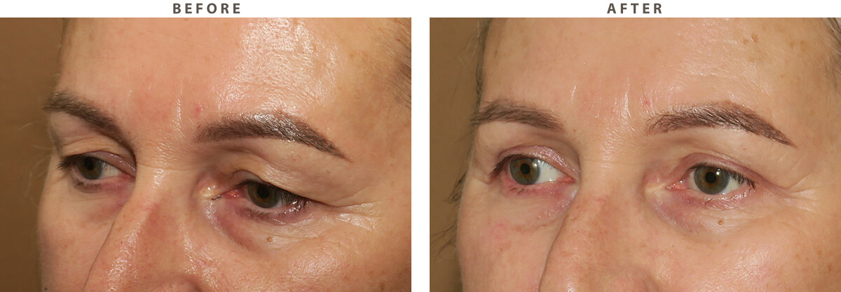Blepharoplasty Chicago - Before and After Pictures