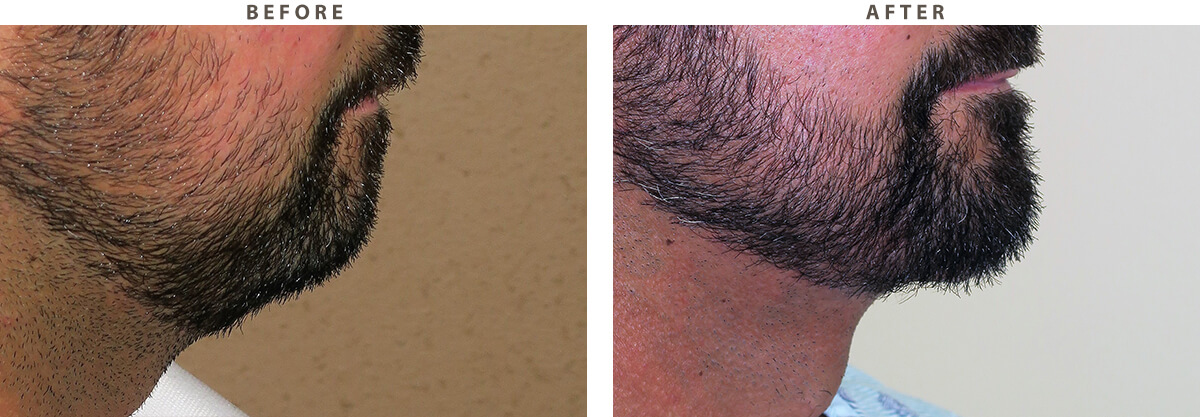 Necklift Chicago - Before and After Pictures