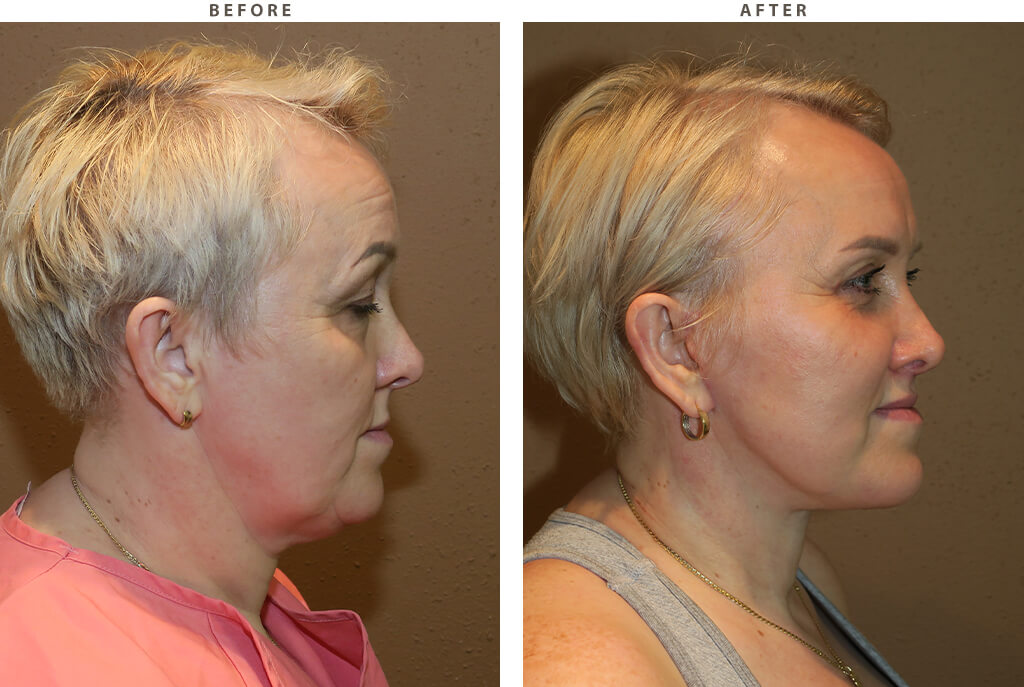 Facelift Chicago - Before and After Pictures