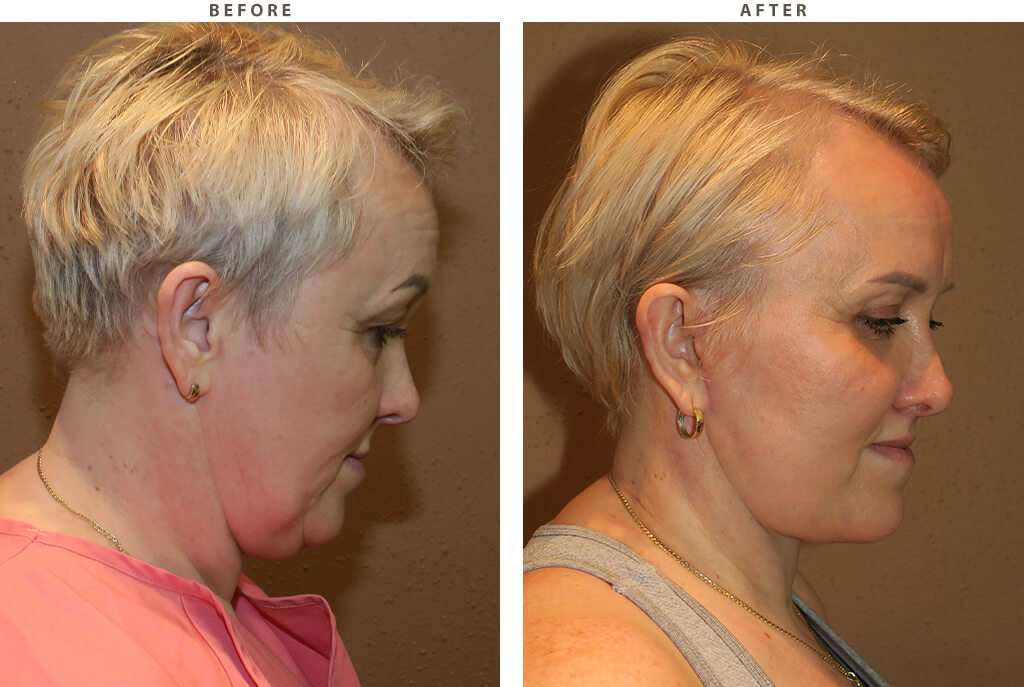 Facelift Chicago - Before and After Pictures