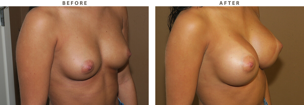 Breast augmentation Chicago - Before and After Pictures