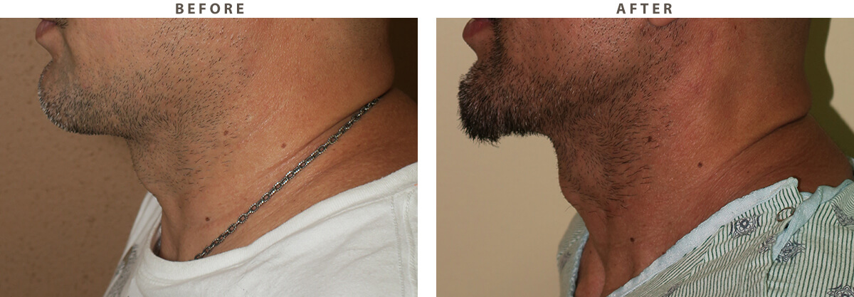 Facelift Chicago - Before and After Pictures