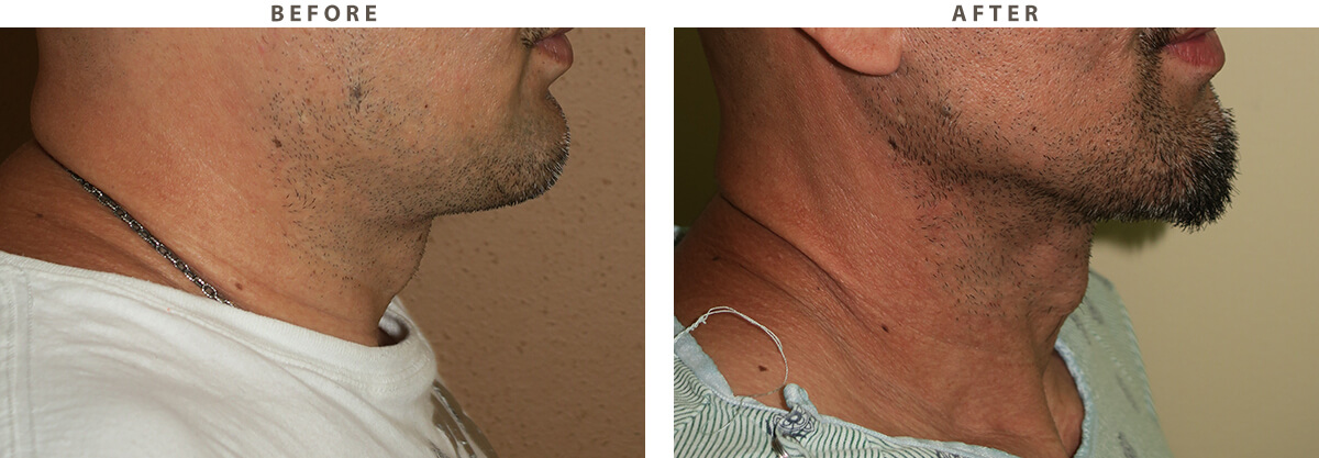 Facelift Chicago - Before and After Pictures