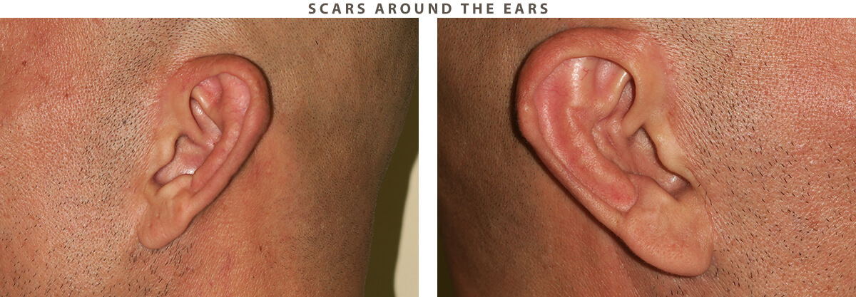 Facelift Chicago - Before and After Pictures