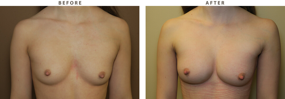 Breast augmentation Chicago - Ballerina implants - Before and After Pictures