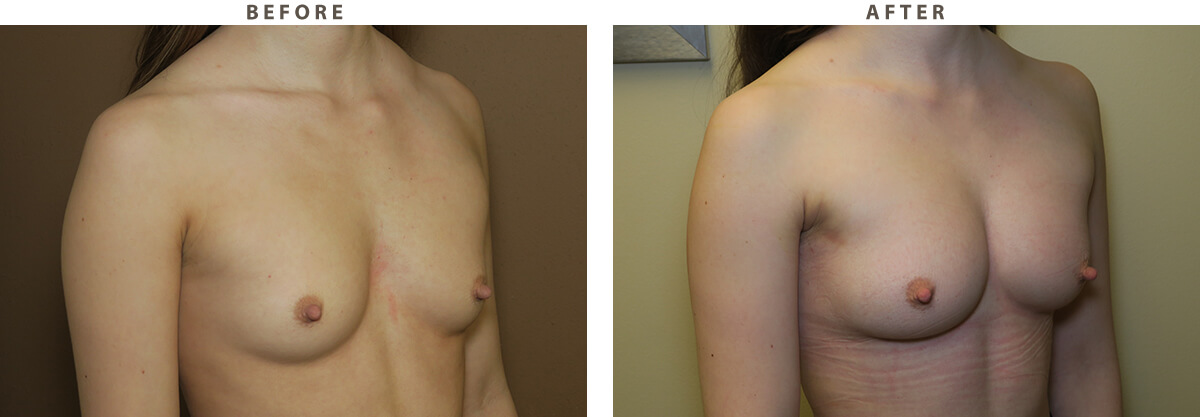 Breast augmentation Chicago - Ballerina implants - Before and After Pictures