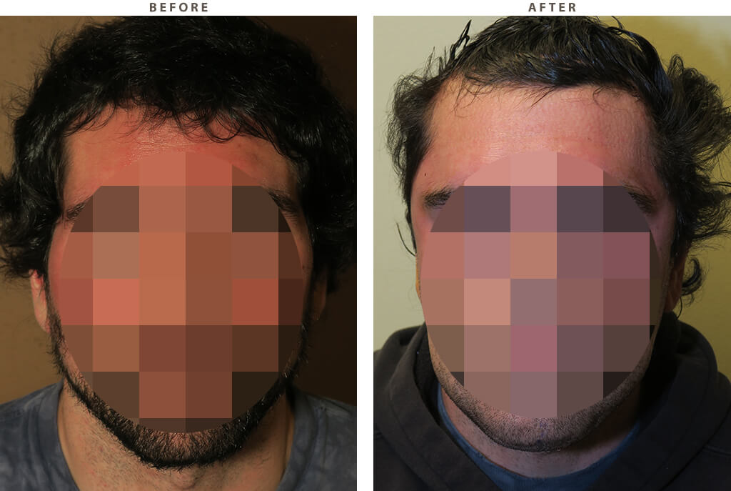 Temporal implants Chicago - Before and After Pictures