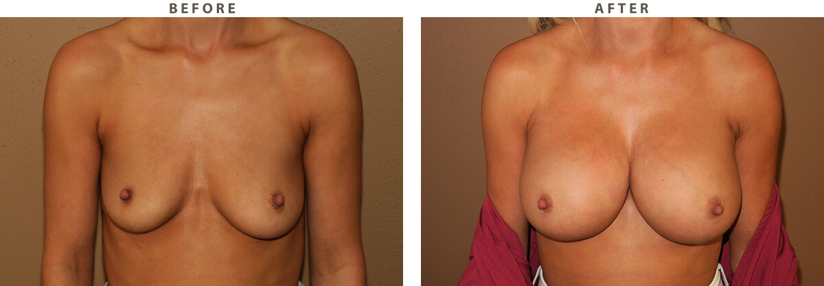 Breast augmentation Chicago - Ballerina implants - Before and After Pictures