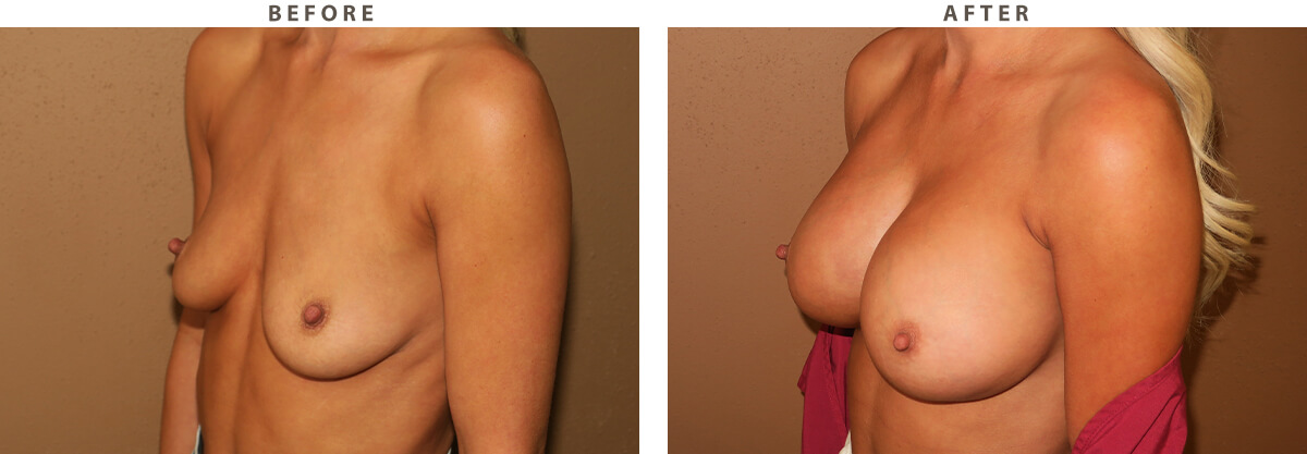 Breast augmentation Chicago - Ballerina implants - Before and After Pictures