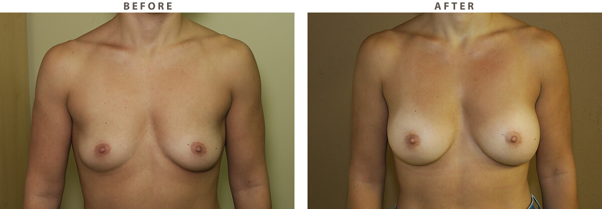 Ballerina breast augmentation Chicago - Before and After Pictures