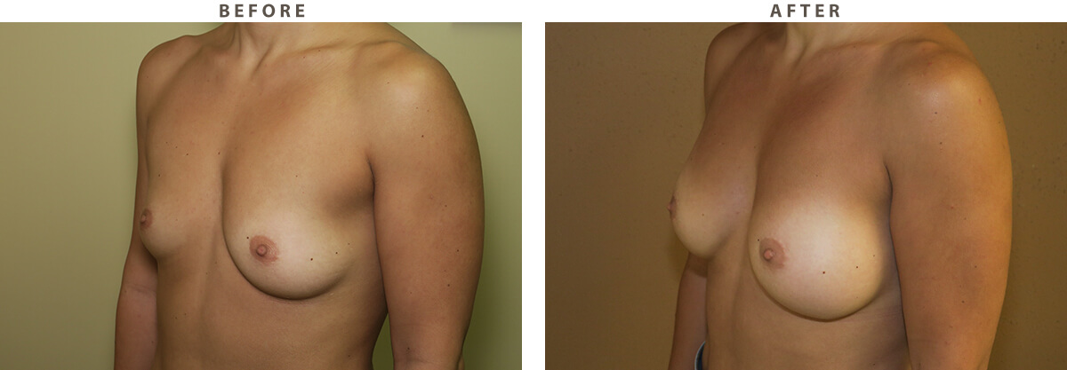 Ballerina breast augmentation Chicago - Before and After Pictures