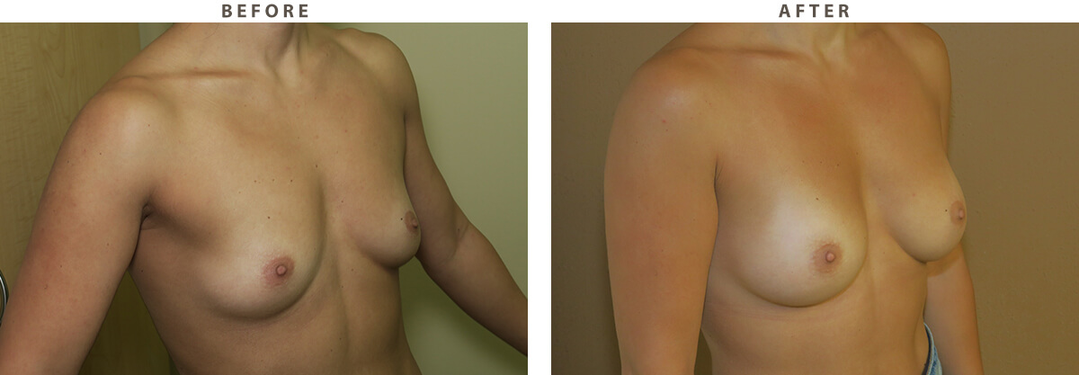 Ballerina breast augmentation Chicago - Before and After Pictures