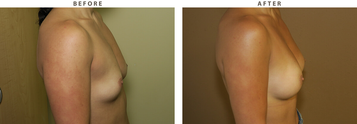 Ballerina breast augmentation Chicago - Before and After Pictures