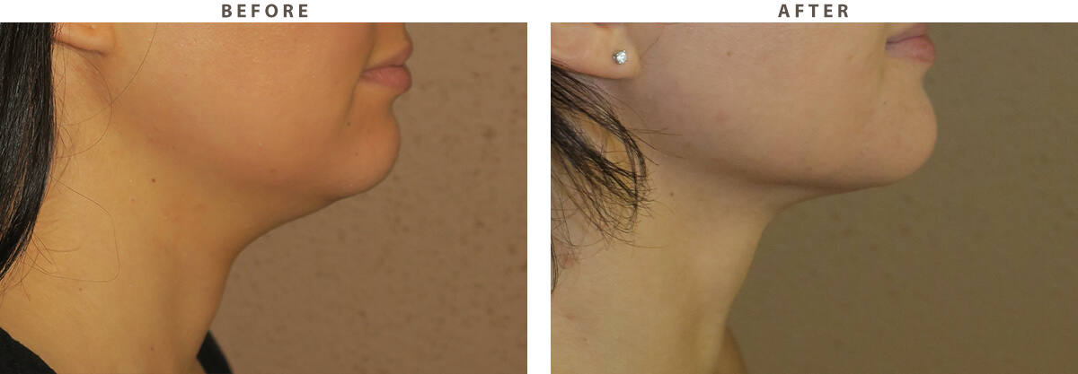 Neck liposuction Chicago - Before and After Pictures