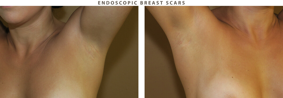 Endoscopic breast scars Chicago - Before and After Pictures