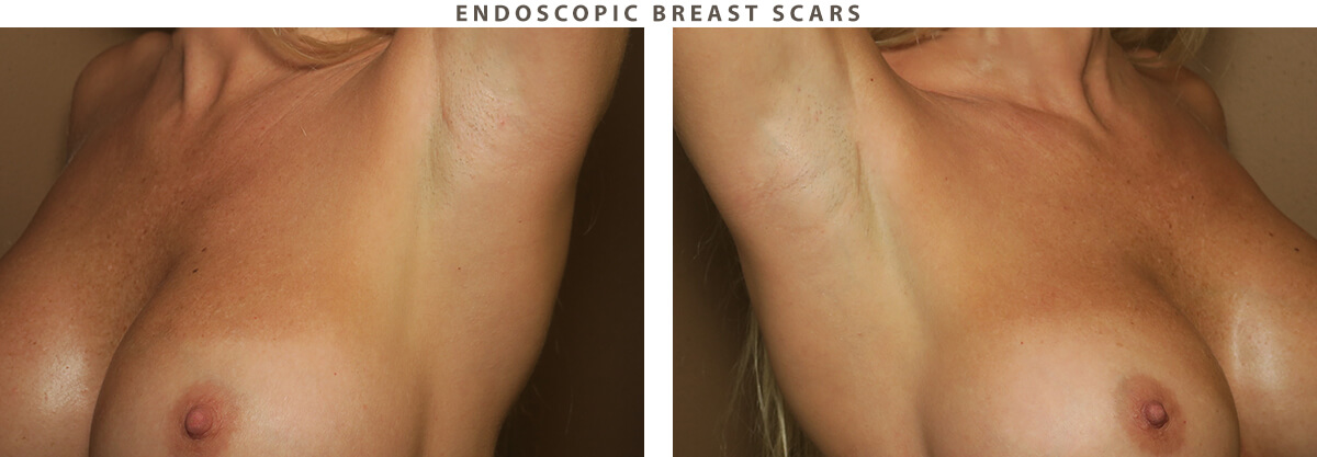 Endoscopic breast scars Chicago - Before and After Pictures
