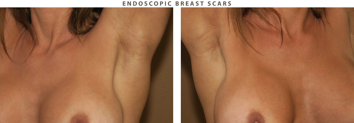 Endoscopic breast scars Chicago - Before and After Pictures