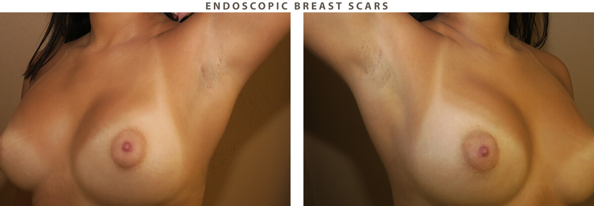 Endoscopic breast scars Chicago - Before and After Pictures