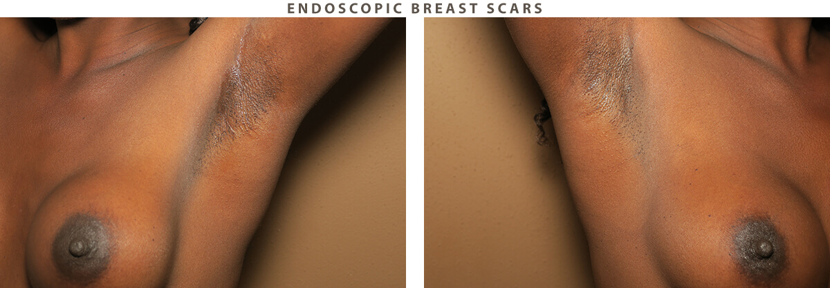 Endoscopic breast scars Chicago - Before and After Pictures