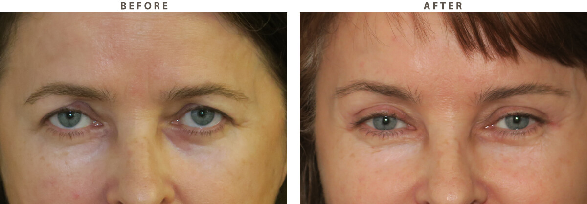 Blepharoplasty Chicago - Before and After Pictures