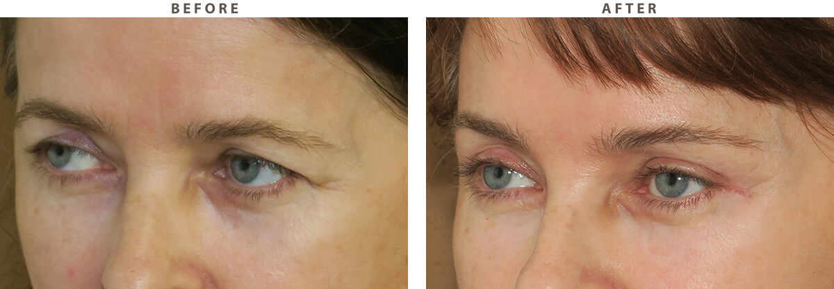Blepharoplasty Chicago - Before and After Pictures