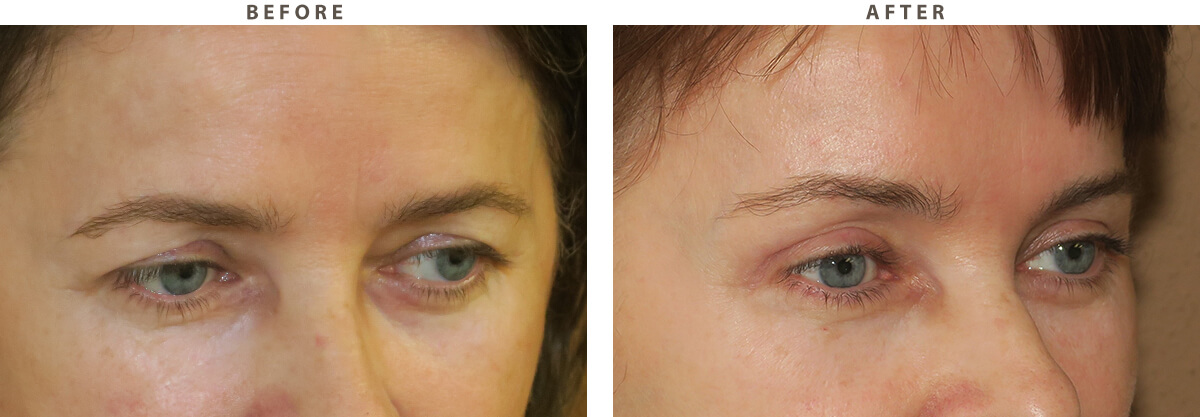 Blepharoplasty Chicago - Before and After Pictures