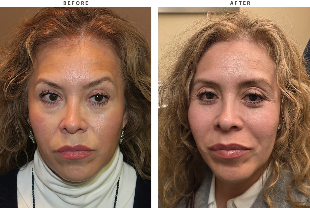 Midface lift Chicago - Before and After Pictures