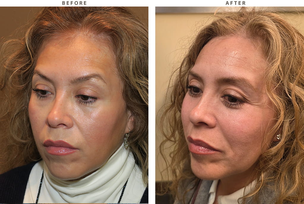 Midface lift Chicago - Before and After Pictures