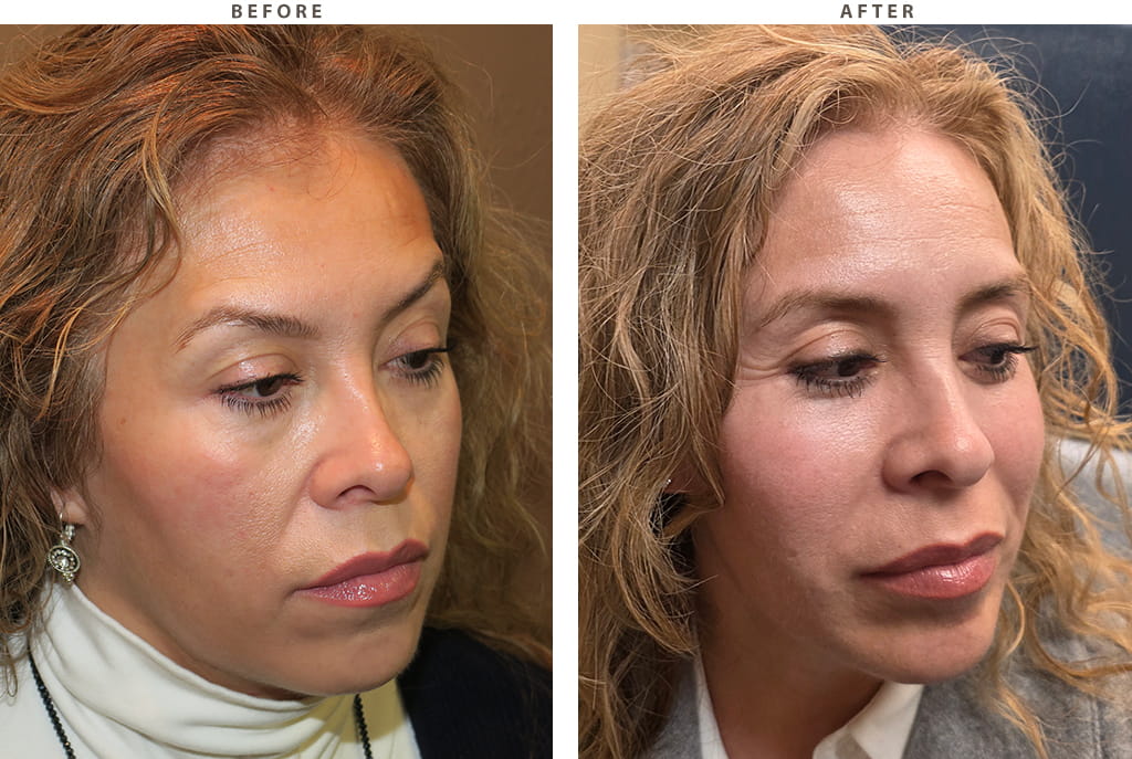 Midface lift Chicago - Before and After Pictures