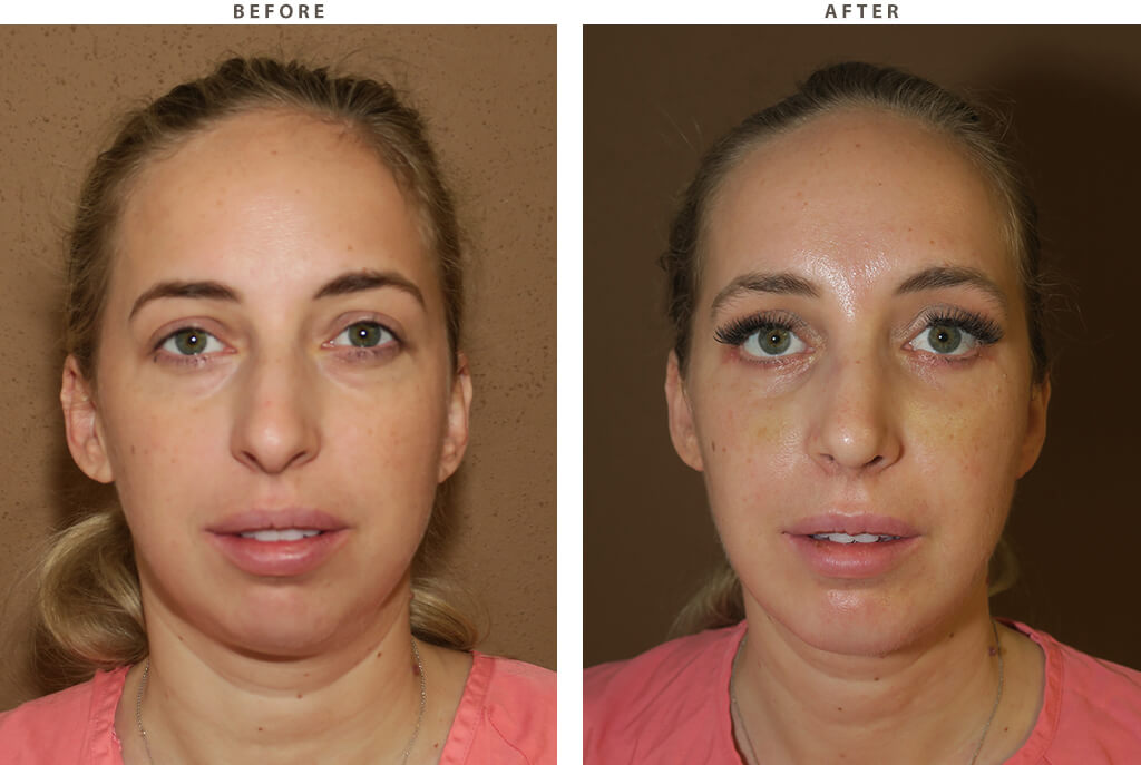 Chin augmentation - Before and After Pictures