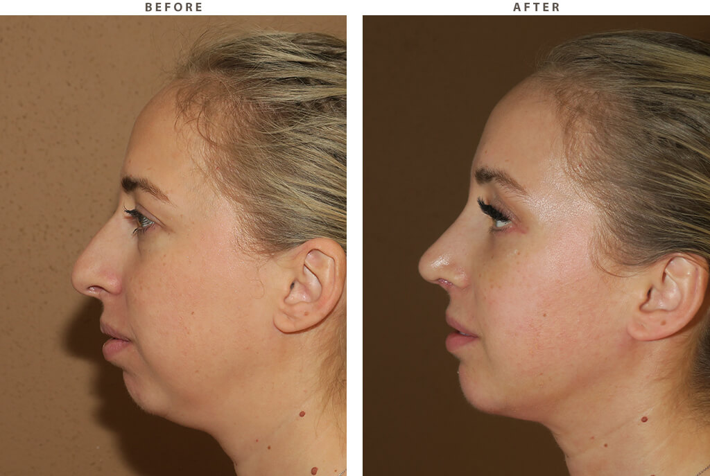 Chin augmentation - Before and After Pictures