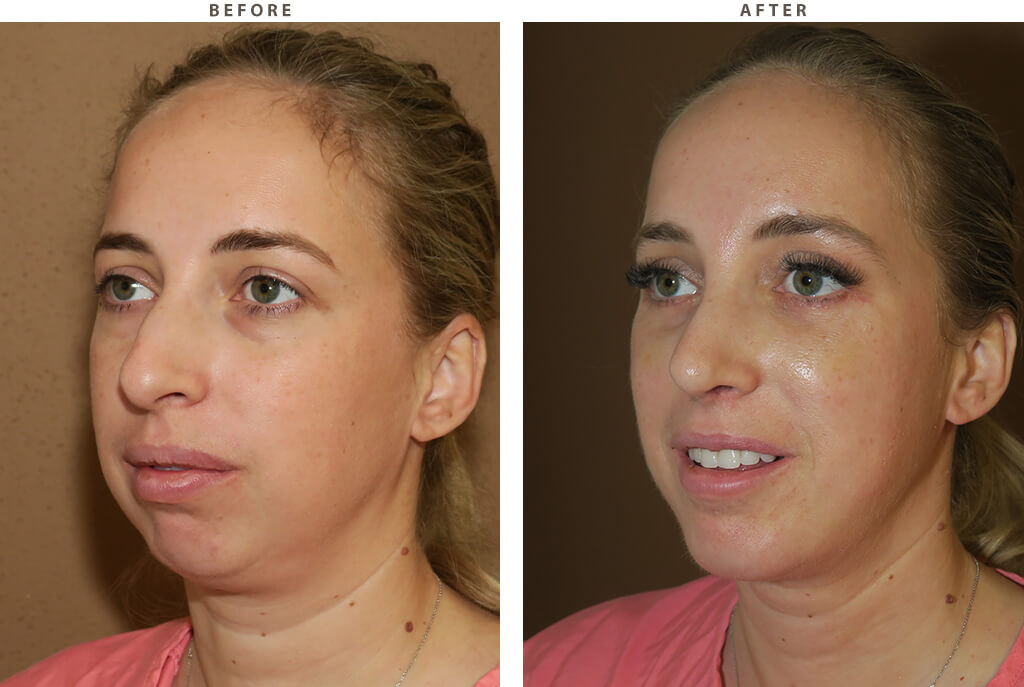 Chin augmentation - Before and After Pictures