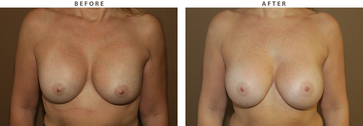 Breast revision Chicago - Before and After Pictures