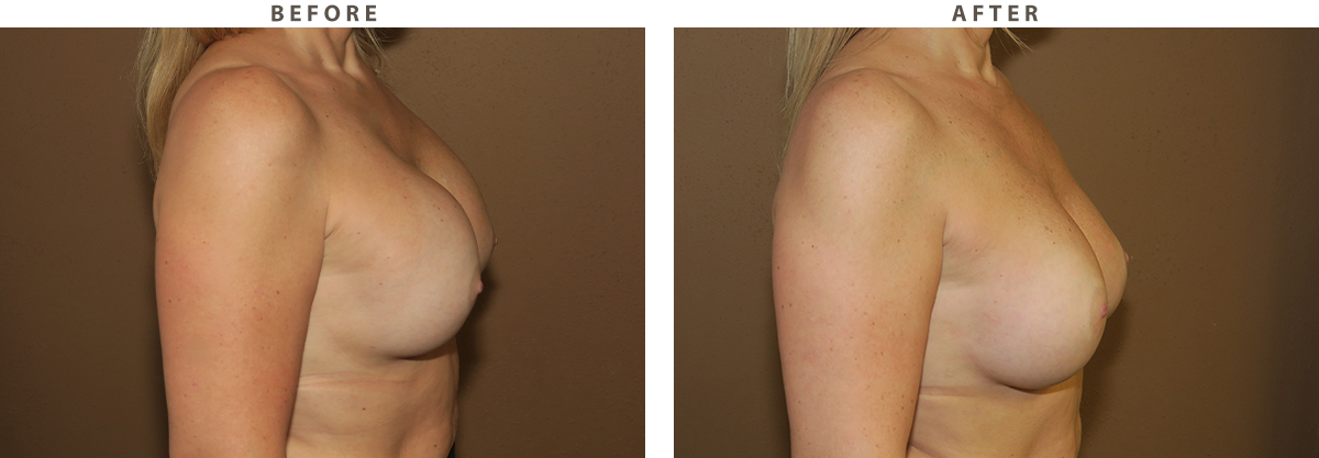 Breast revision Chicago - Before and After Pictures