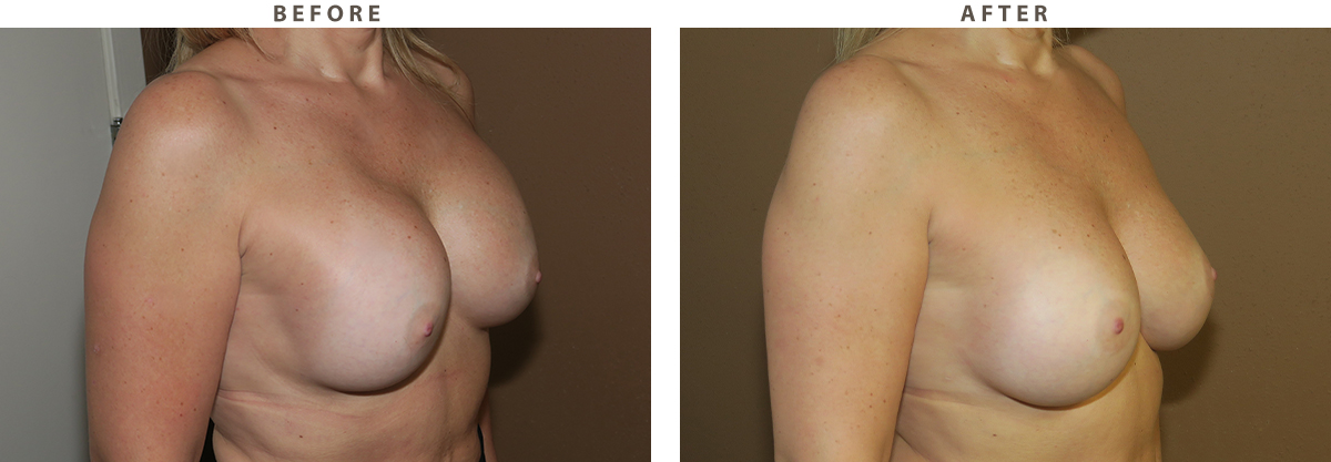 Breast revision Chicago - Before and After Pictures
