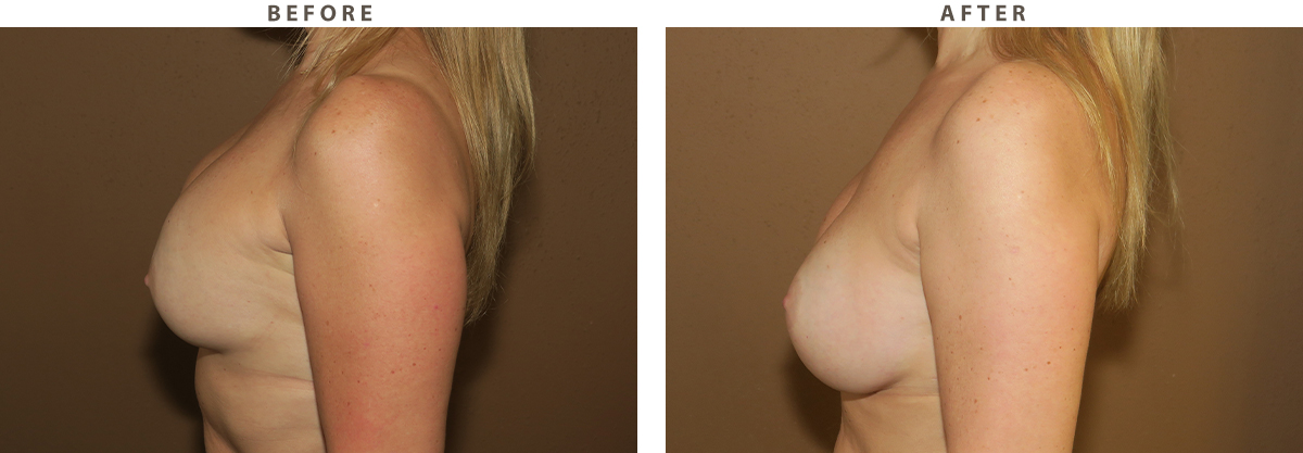 Breast revision Chicago - Before and After Pictures