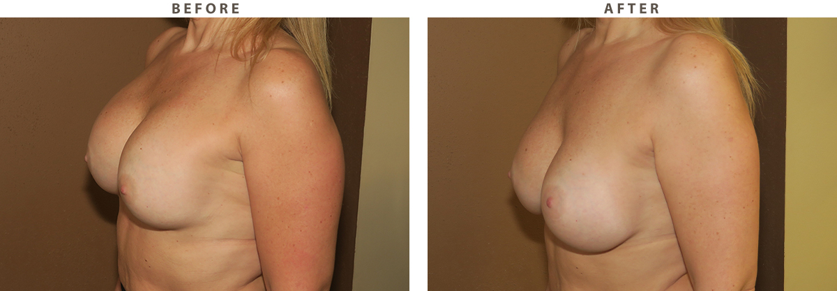 Breast revision Chicago - Before and After Pictures