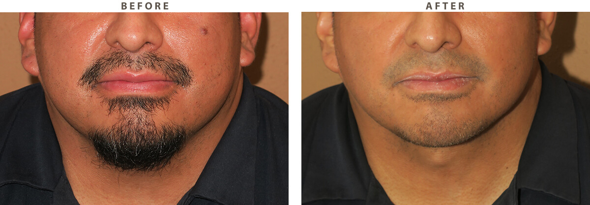 Neck lift Chicago - Before and After Pictures