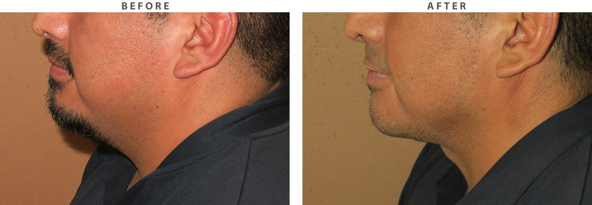 Neck lift Chicago - Before and After Pictures