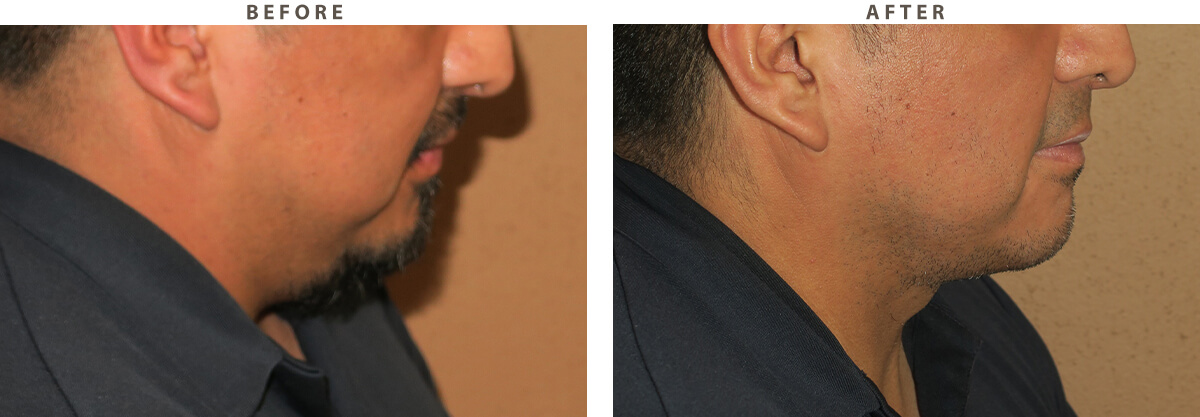 Neck lift Chicago - Before and After Pictures