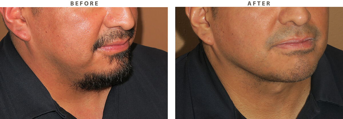 Neck lift Chicago - Before and After Pictures