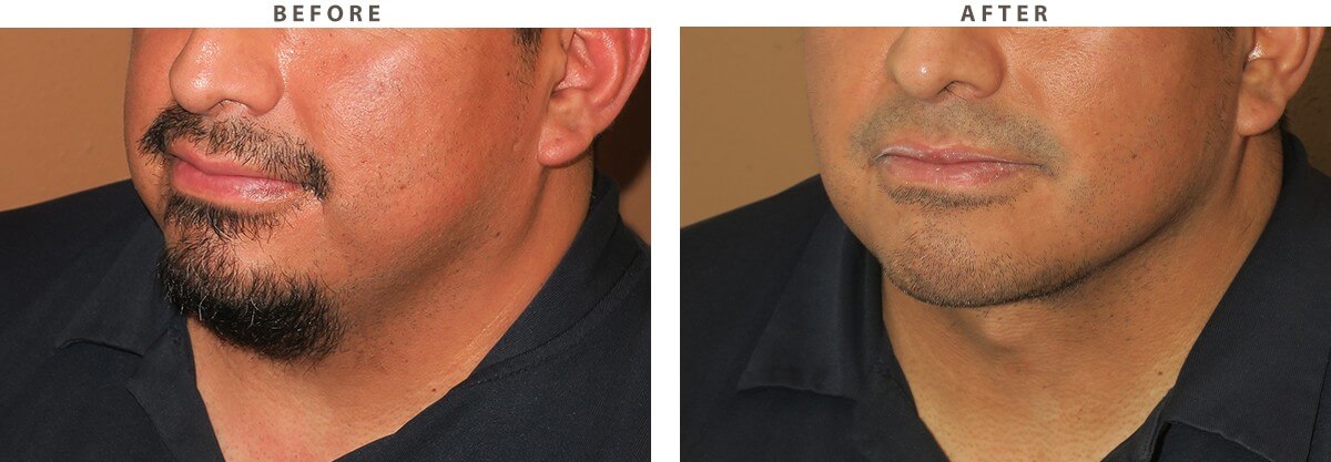 Neck lift Chicago - Before and After Pictures